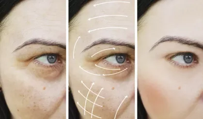 Kabusunuz olmasın! Uzman doktordan göz altı morluklarına çözüm: Göz altı morluklarından nasıl kurtulabilirim?